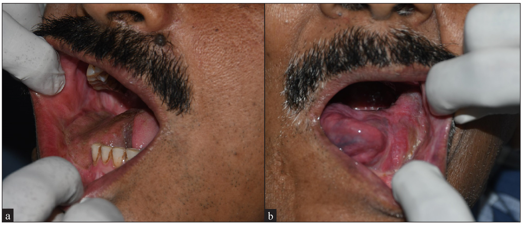 No regrowth of hair in both patients after 3 laser sessions and 2-year follow up.