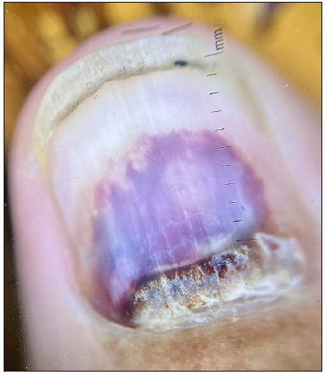 The haematoma displays a convex distal border of onycholysis precisely parallel to the distal nail fold (Dermlite DL3N, x10).