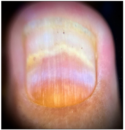 Rising-sun appearance with the convex semicircular distal yellowish-white band at the lesion’s distal edge, indicating the deposition of purulent material at the haematoma’s distal border with orangish discoloration of the proximal nail bed (Dermlite DL3N, x10).