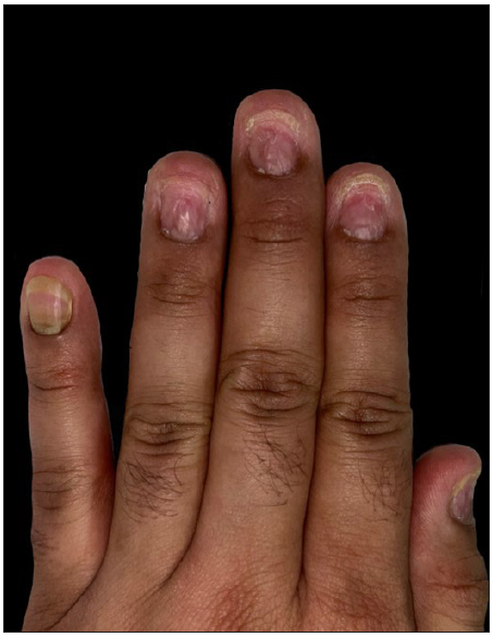 Fingernails of the left hand.
