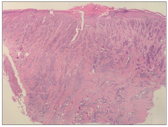 Histopathology image shows epidermis with compact keratosis with flattened rete pigs. Dermis shows variable-sized infiltrating islands of monotonous tumour cells forming trabeculae (Haematoxylin and eosin, 40x).
