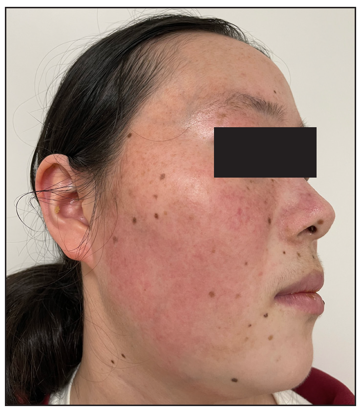 Historical photograph showing the clinical condition prior to the current presentation: Note erythema and telangiectasia on the forehead, cheeks, nose, and eyelids.