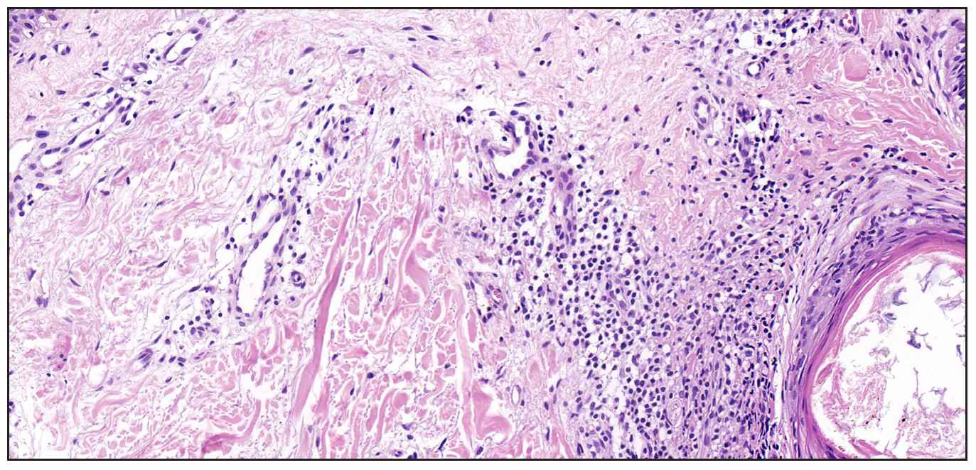 Histopathological features. Histopathological examination of the skin from the patient’s cheek revealed scattered or focal lymphocytes and histiocytes surrounding the vessels in the superficial to mid-dermis. (Haematoxylin and eosin, 100x).