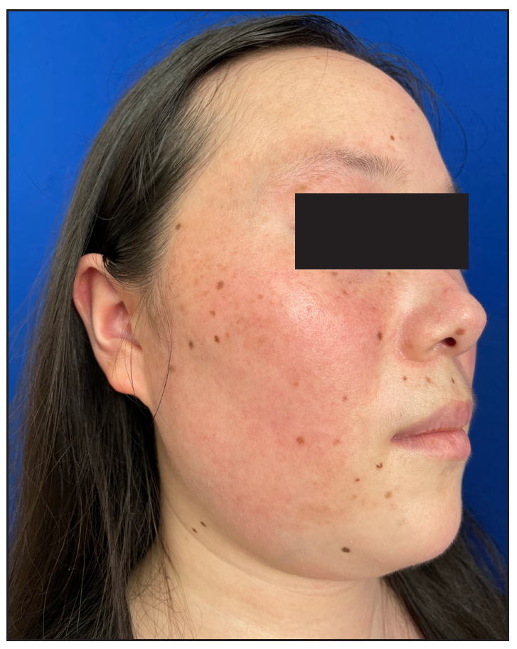 After 3 weeks of TaVNS treatment: The adherent crusts and edema completely resolved, erythema and telangiectasia showed significant improvement.