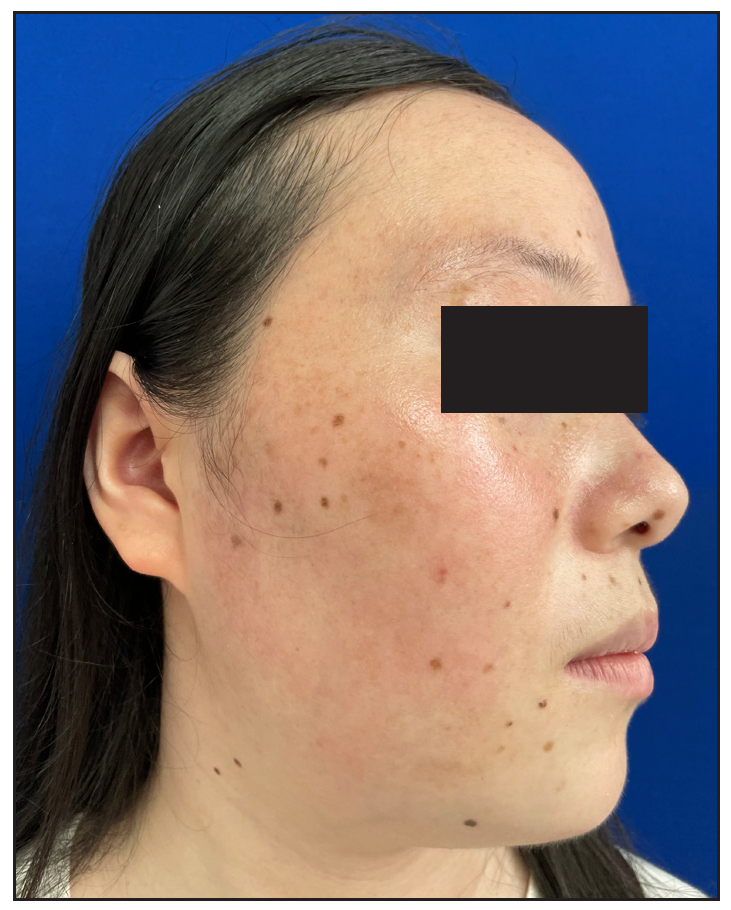 Follow-up after 6 months without treatment: Facial erythema and telangiectasia further alleviated and there was no recurrence of crust formation.