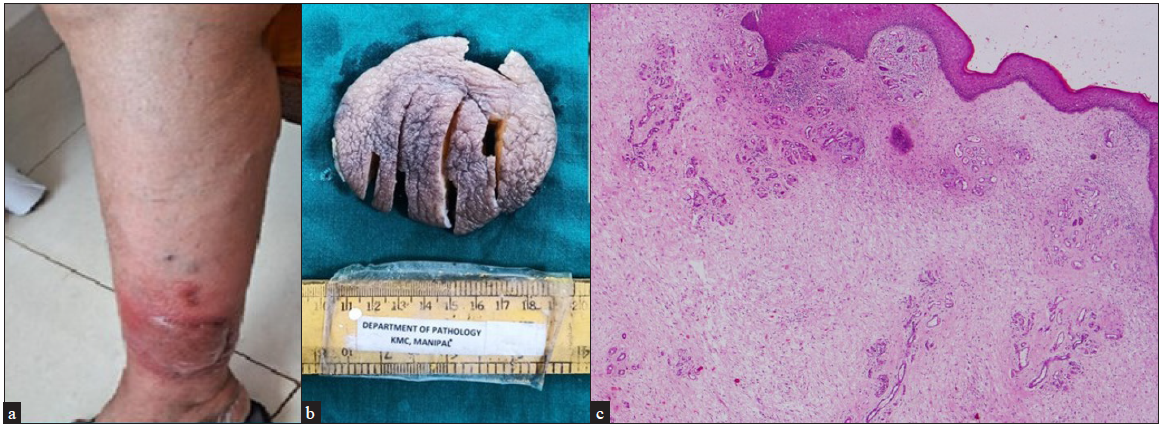 (a) Erythematous nodular plaque over the left leg, (b) Excised plaque showing irregular nodular surface, (c) Histology showing atrophic epidermis with focal acanthosis overlying numerous vertically oriented vessels surrounded by myxoid stroma with stellate fibroblasts (Haematoxylin and eosin, 200x).