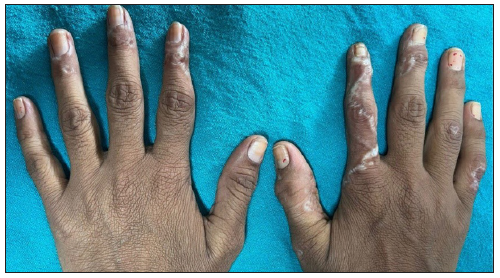 Depigmented atrophic linear plaques extending up to the fingertips and leading to atrophy and thinning of finger pulp of both index fingers.