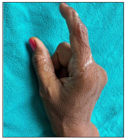 Partial fixed flexion deformity of the right index finger.