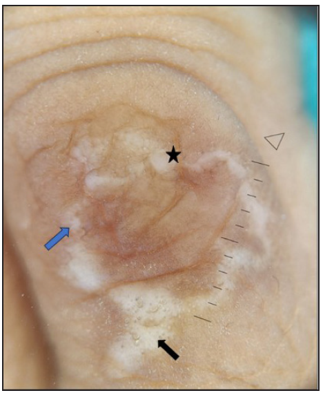 Dermoscopy shows well-defined white structureless areas with overlying multiple follicular plugs (black star). There are a few ill-defined shiny, whitish linear streaks within the white structureless area known as chrysalis-like structures (blue arrow and black arrow) (Dermlite 4, non-polarising mode, 20x).