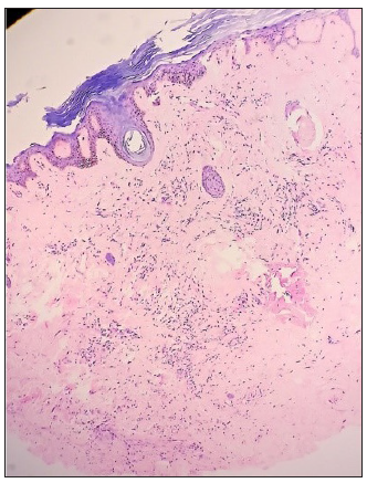 Thinned-out atrophic epidermis with hyperkeratosis, follicular plugging, sclerosis and dense homogenisation of the collagen reaching up to the deep reticular dermis and interstitial lymphocytic infiltrate. (Haematoxylin and eosin, 40x).