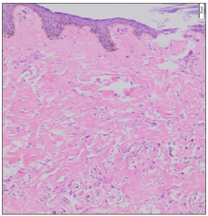 Mild interstitial lymphocytic inflammatory infiltrate is noted in the dermis interspersed within the zone of homogenised collagen bundles. (Haematoxylin and eosin, 100x).