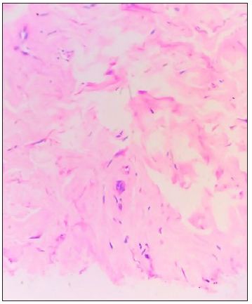 Homogenisation of the collagen noted up to the deeper dermis with mild interstitial lymphocytic infiltrate. (Haematoxylin and eosin, 200x).