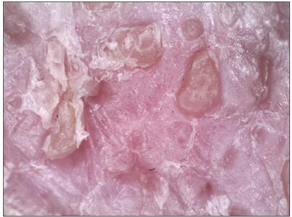 Dermoscopy of the lesion showing multiple white structureless areas on a pinkish background with multiple superficial white scales (Dermlite DL4, Non-polarised, 10x magnification).