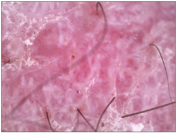 Polarised dermoscopy of the lesion showing multiple white shiny lines with glomerular vessels (Dermlite DL4, polarised, 10x magnification).