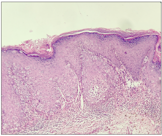 Epidermis showing multiple, round to oval atypical cells with abundant amphophilic cytoplasm and conspicuous nucleoli. Few mitotic figures are also seen. (Haematoxylin and eosin, 10x).