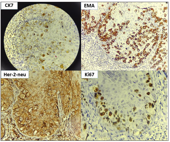 Immunohistochemistry (IHC) showing cells with positivity for CK7, epithelial membrane antigen (EMA), Her-2-neu, and elevated Ki67 (IHC, 40x).