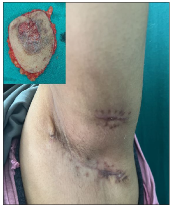 Image of the patient at 3 months post-surgery. Inset showing excised specimen.