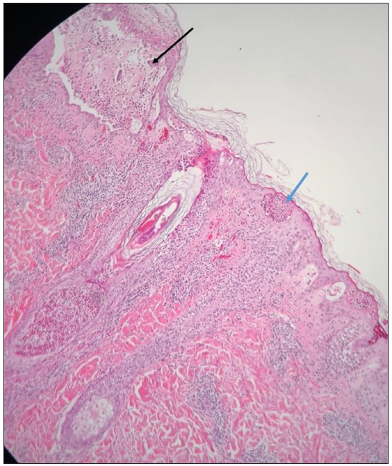 Intraepidermal bulla (black arrow) filled with mixed inflammatory infiltrate admixed with acantholytic cells. Mild focal spongiosis and multiple abscesses (blue arrow) filled with mixed inflammatory cells (Haematoxylin and Eosin, 100x).
