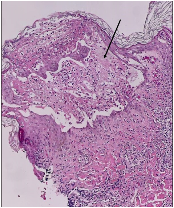 Bulla (black arrow) closer view (Haematoxylin and eosin, 200x).