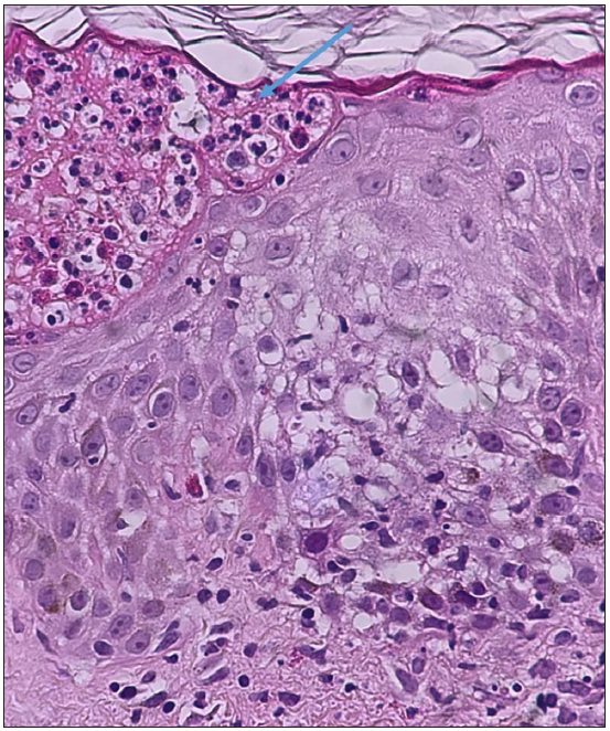 Mild epidermal spongiosis and intraepidermal abscess (blue arrow) filled with neutrophils, eosinophils and lymphocytes (Haematoxylin and Eosin, 400x).