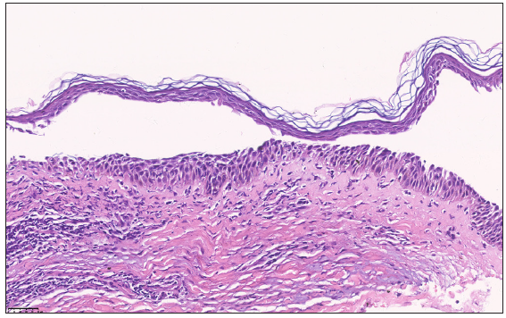 Histopathological examination showed mid-epidermal clefts containing acantholytic cells. (Haematoxylin and eosin, 100x)