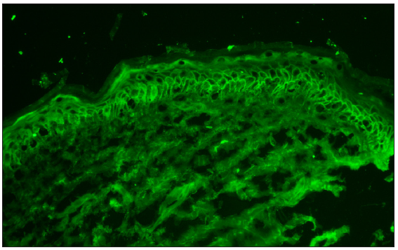 Direct immunofluorescence on the normal-appearing perilesional skin revealed intercellular IgG staining in the epidermis. (200x).