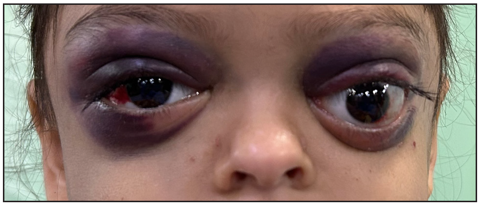 Bilateral periorbital ecchymosis, swelling, subconjunctival haemorrhage and proptosis of left eye.