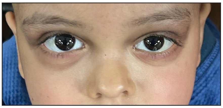 Normal appearance of the eyes post-chemotherapy for neuroblastoma.