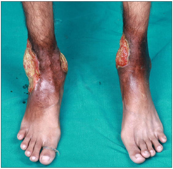 Three well-defined, irregularly marginated ulcers, the largest of size 14×10 cm on the medial and lateral malleolar aspect.