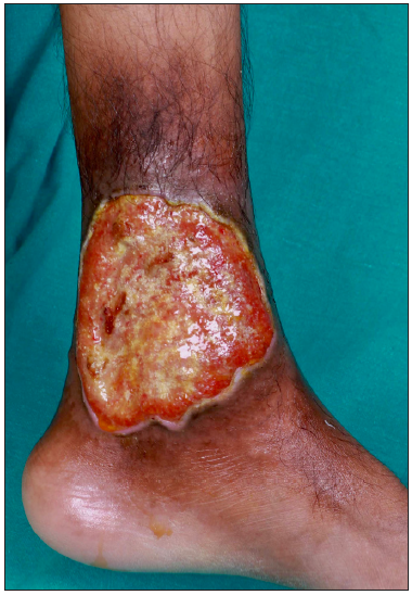 The largest ulcer with focally undermined edges and floor covered with yellowish to brownish necrotic slough with serosanguinous discharge and perilesional hyperpigmentation.