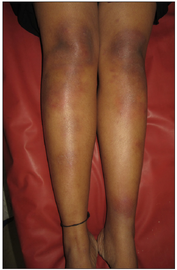 Multiple tender erythematous plaques and nodules over anterior aspect of legs suggestive of erythema nodosum.