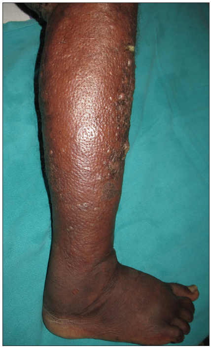 Erythematous oedematous plaque with peau d’orange surface and hyperkeratotic warty papules over right leg suggestive of lymphedema.