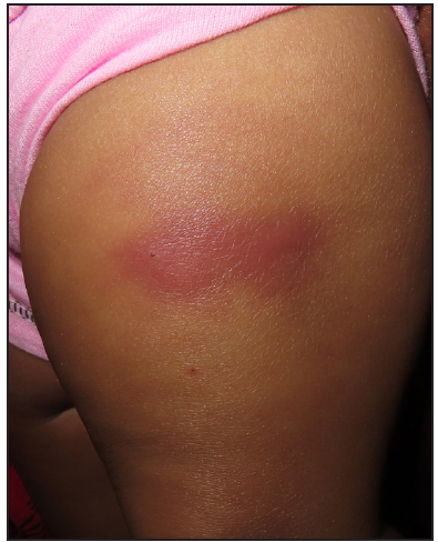 Target-like erythematous indurated plaque over left thigh following diphtheria pertussis tetanus injection.