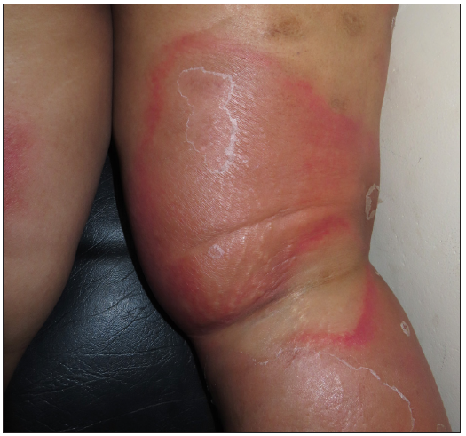 Well-defined erythematous patch with central clearing and a collarette of scales at the periphery suggestive of erythema chronicum migrans.