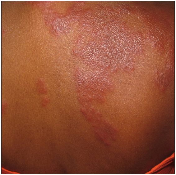 Multiple discrete to coalescing oedematous to pseudo vesicular erythematous tender plaques over the upper back suggestive of sweet syndrome.