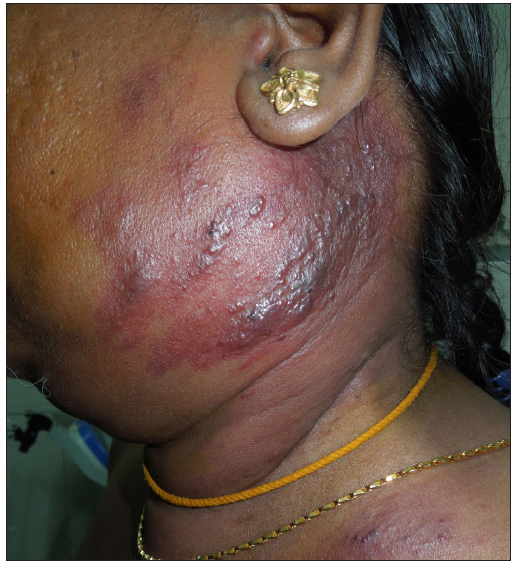 Multiple papulonodular lesions over an infiltrated erythematous plaque over the left cheek and neck region suggestive of carcinoma erysipeloides.