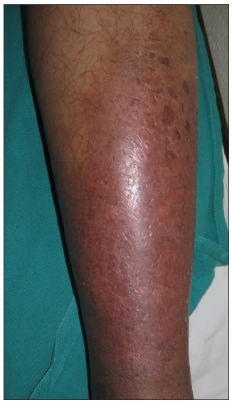 Circumferential erythematous indurated plaque over left lower limb suggestive of acute lipodermatosclerosis.