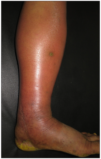 Ill-defined tender erythematous swelling involving lower 2/3rd of the leg suggestive of cellulitis.