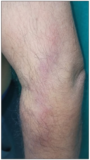 Linear erythematous streak over the medial aspect of leg and thigh suggestive of lymphangitis.