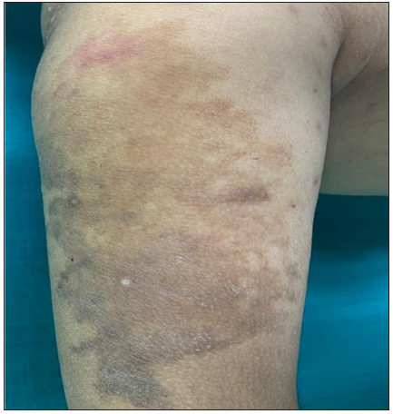 Hyperpigmentation after three sessions of foam sclerotherapy at a monthly interval.