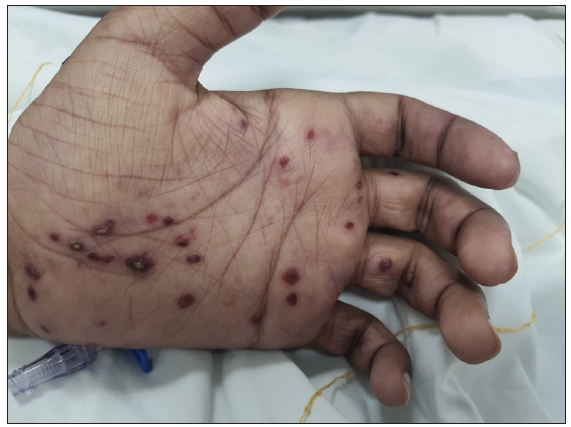 Multiple, discrete, dusky purpuric macules and papules with central necrosis over palms and soles.