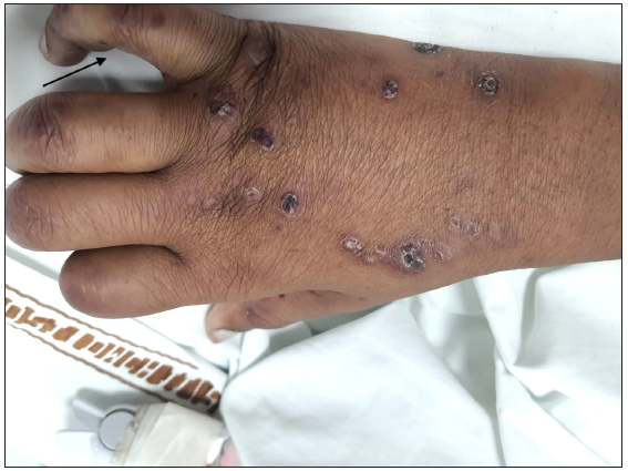 Diffuse non-pitting edema appreciated over hands with ulnar clawing appreciated on the right side (black arrow) and overlying discrete punched-out ulcers with central vasculonecrotic changes.