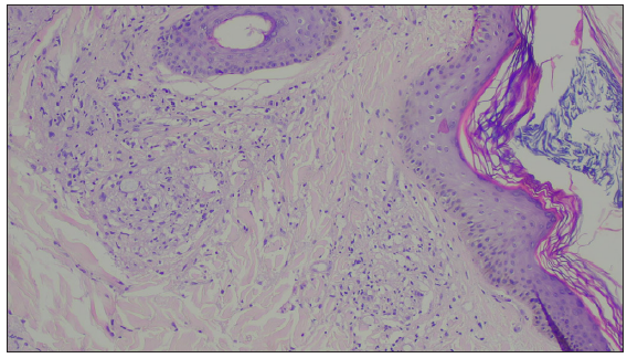 Epidermal atrophy with diffuse dermal lymphocytic and neutrophilic infiltrate and foamy macrophages laden with acid-fast bacilli, consistent with lepromatous leprosy with ENL (Haematoxylin and eosin, 400×).