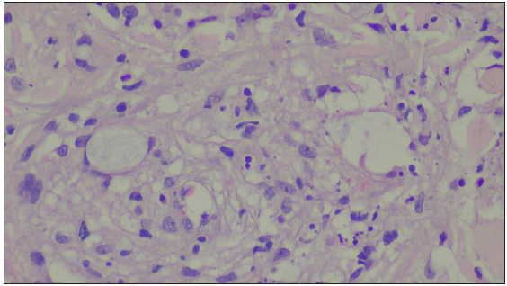 Leukocytoclasia and extravasation of the RBCs, consistent with vasculonecrotic ENL (Haematoxylin and eosin, 400×).