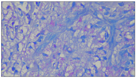 Abundant acid-fast bacilli seen inside the dermal macrophages (Ziehl-Neelsen stain (5%), 1000×).