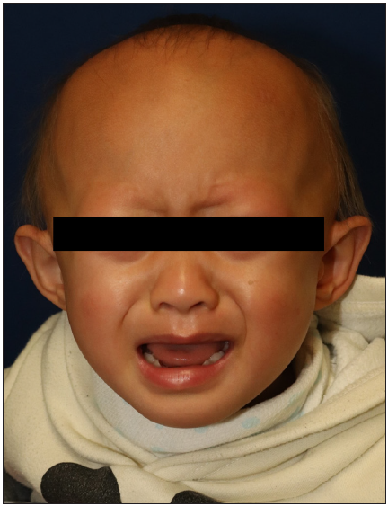 Front view of the patient showing sparse, thin hair, with absence of eyebrows and eyelashes.