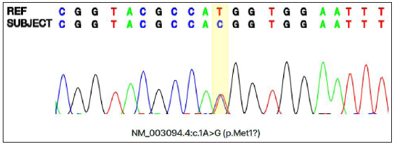 Sequence analysis of SNRPE in the patient revealed a c.1A>G substitution. (A: Adenosine, C: Cytosine, T: Thymine, G: Guanine).