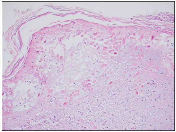 Inguinal lesion showing necrosis and keratinocytes with nuclear enlargement and intranuclear inclusion bodies. A dense perivascular inflammatory infiltrate can be noted in the dermis. (Haematoxylin and eosin, 100x)