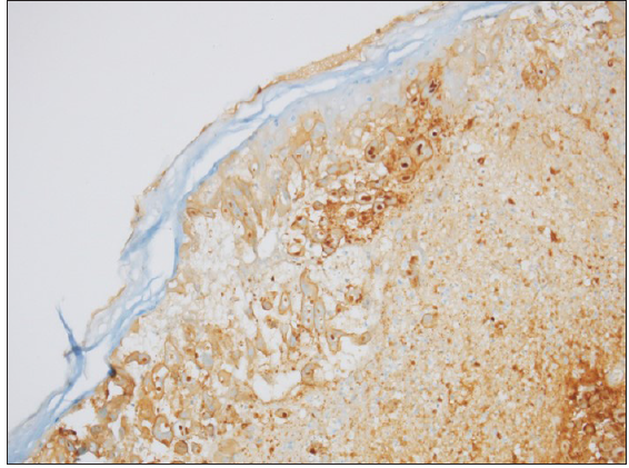 Immunohistochemistry for herpes simplex virus 1 showing nuclear positivity. (IHC Stain: Rabbit polyclonal HSV1 and HSV2 by Cell Marque, 200×)