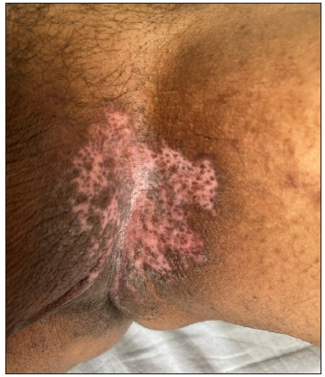 Complete healing with post-inflammatory depigmentation after 3 months of therapy with low-dose naltrexone.
